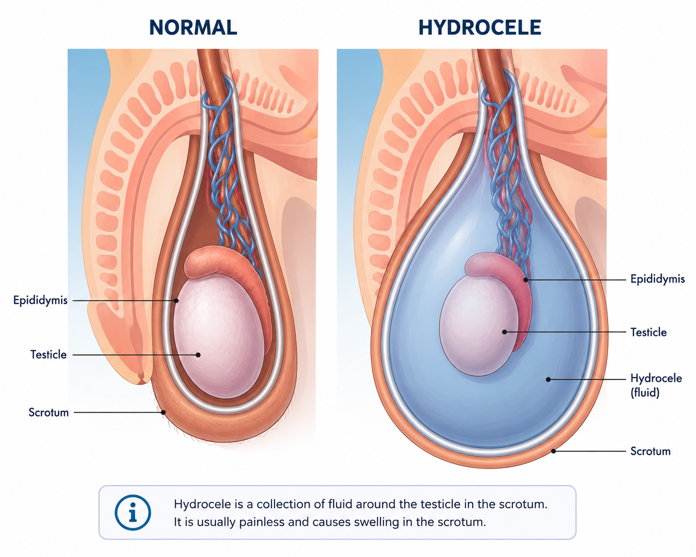Hydrocele diagram